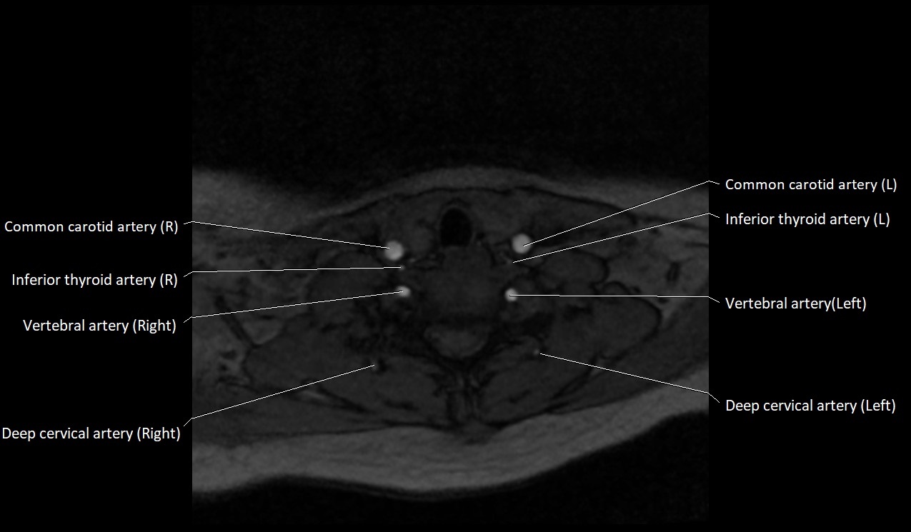 Carotid artery anatomy axial 3T image 56.jpg